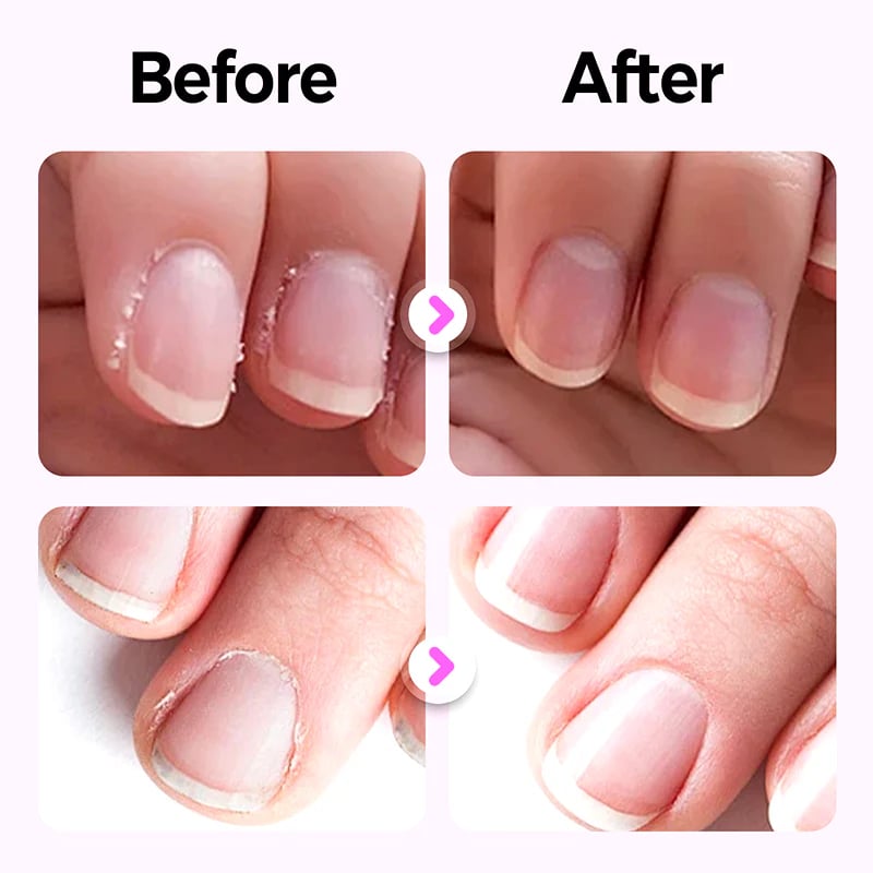 Speciellt för manikyr – nagelvårdspenna, reparerar nagelskador orsakade av manikyr