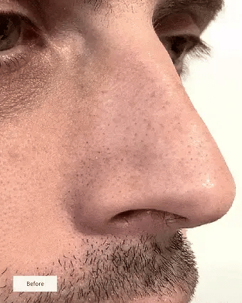 DJUPVERKANDE NÄSPATCH FÖR KLARARE HUD(10 st)