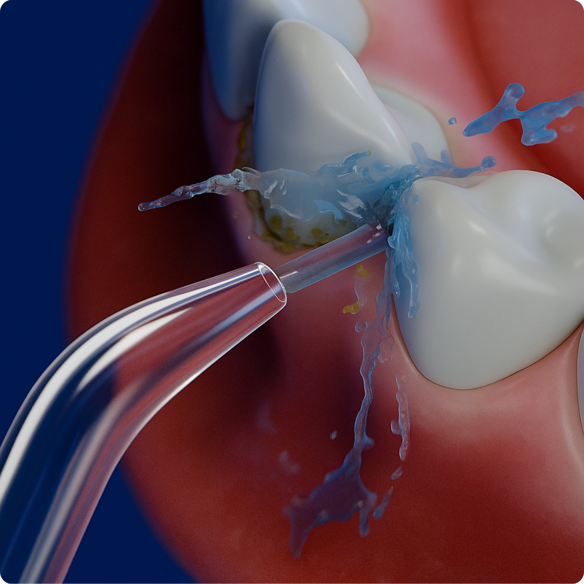 AquaDent™ – Djupgående rengöring där borsten inte räcker