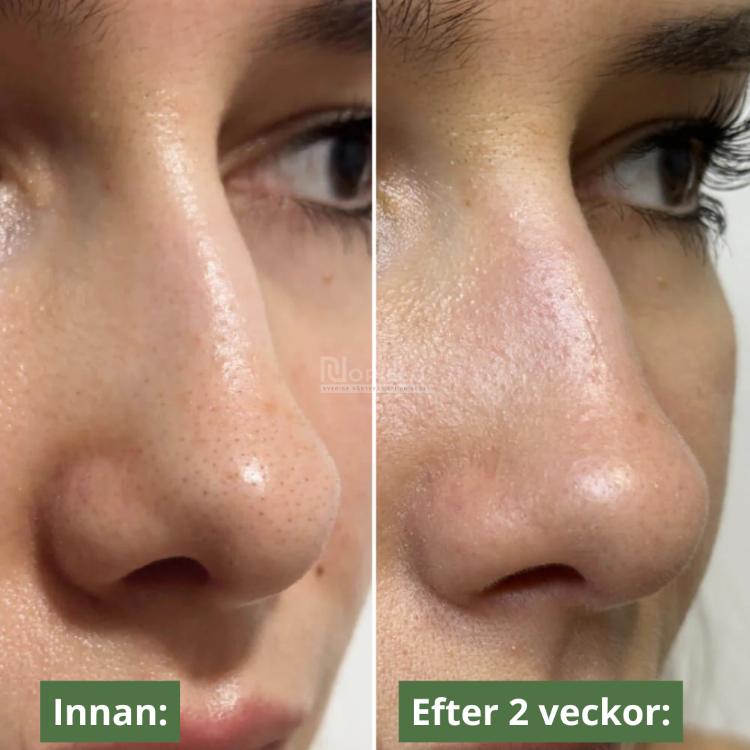 DJUPVERKANDE NÄSPATCH FÖR KLARARE HUD(10 st)